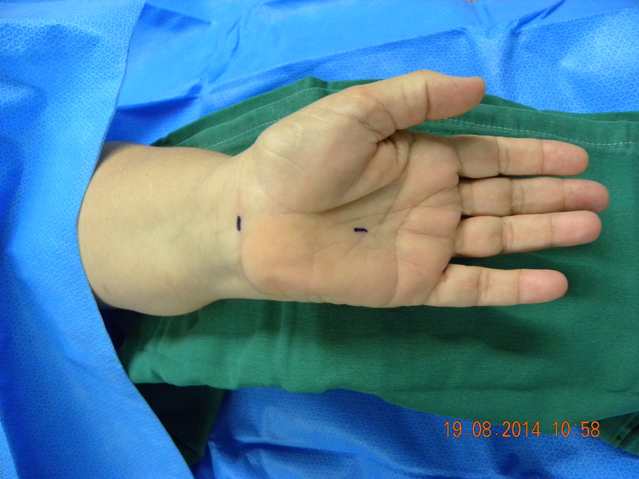 Endoscopic Carpal Tunnel Release 2